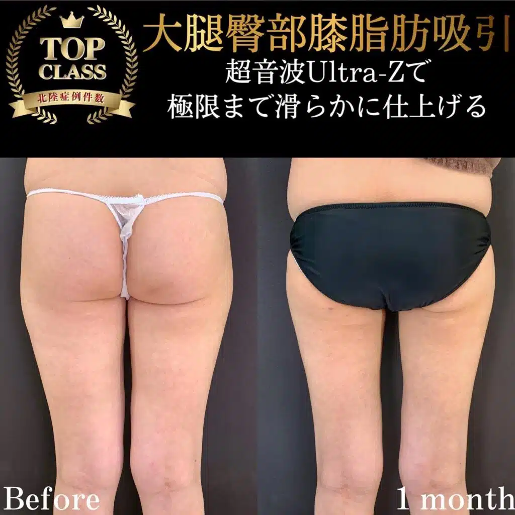 大腿臀部膝脂肪吸引　福岡