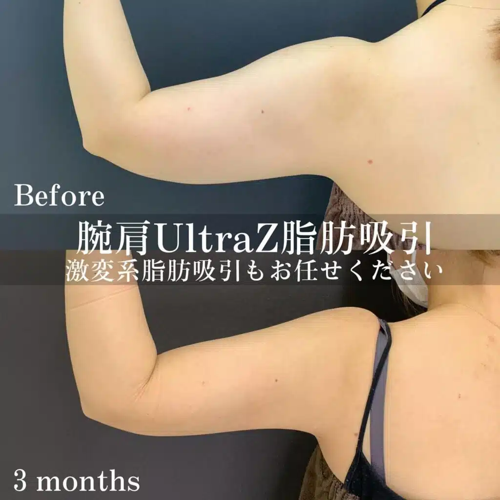 腕肩UltraZ脂肪吸引 福岡