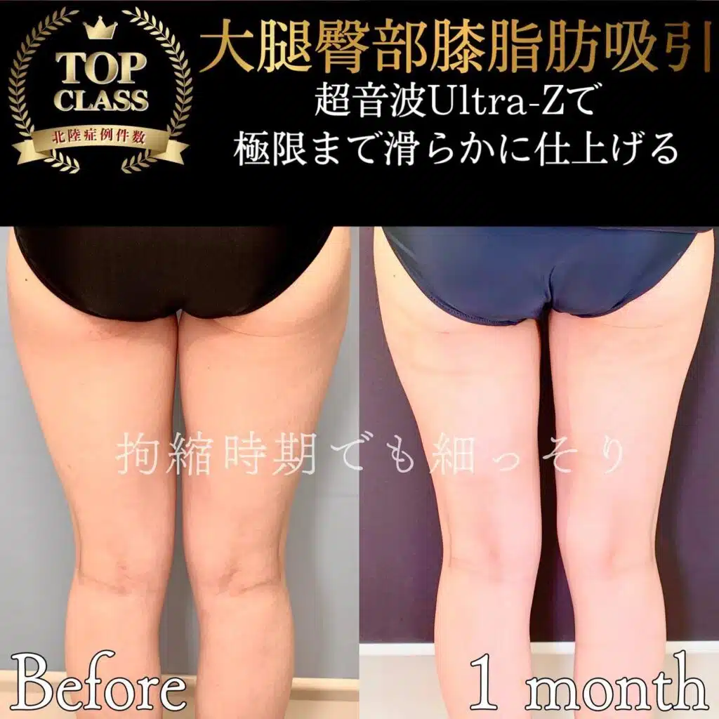 大腿臀部膝脂肪吸引　福岡