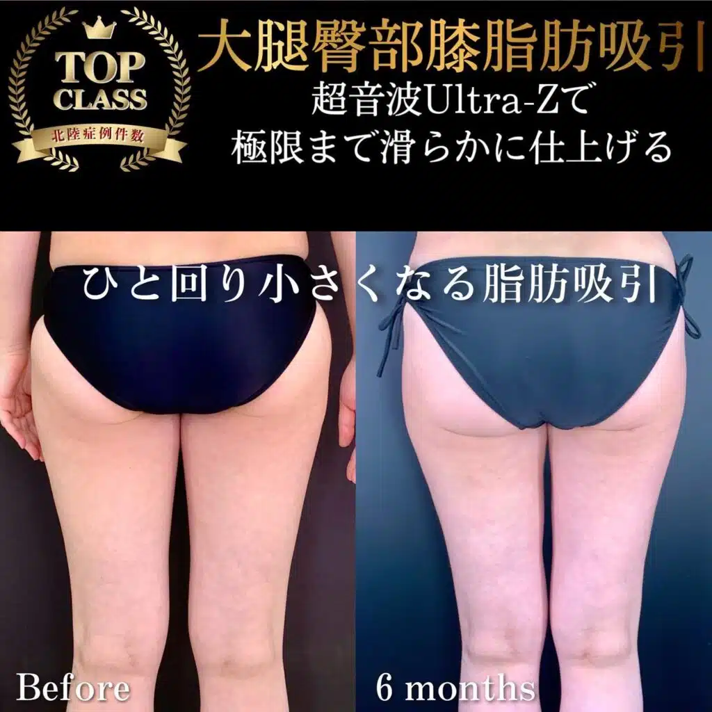 大腿臀部膝脂肪吸引　福岡