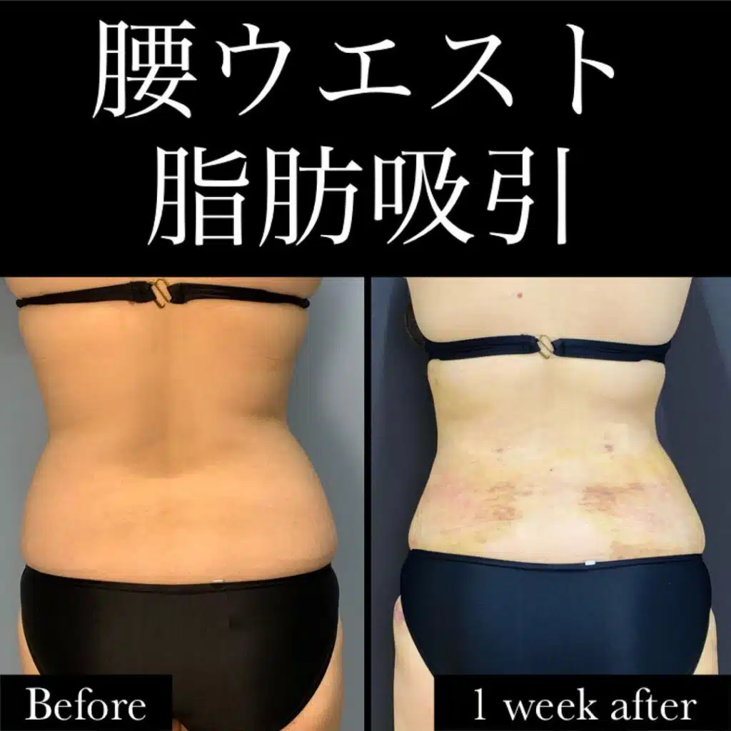 腰ウエスト脂肪吸引　福岡