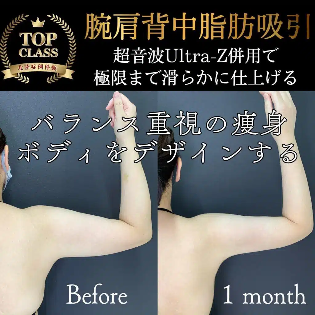 腕肩背中脂肪吸引 福岡