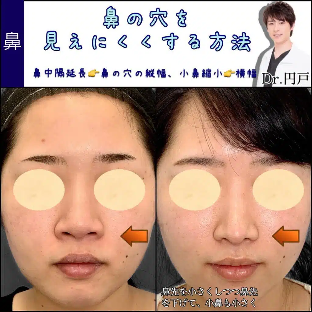 鼻中隔延長　小鼻縮小　福岡