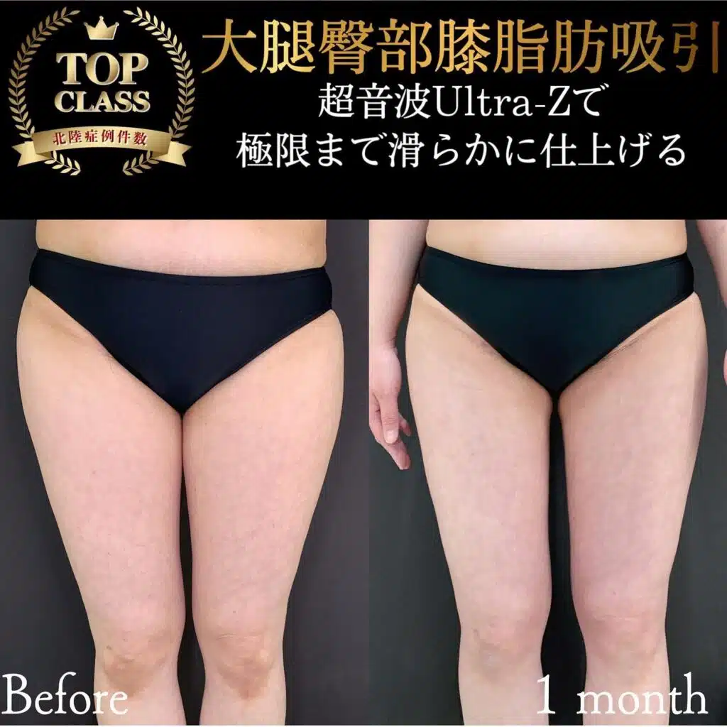 大腿臀部膝脂肪吸引　福岡