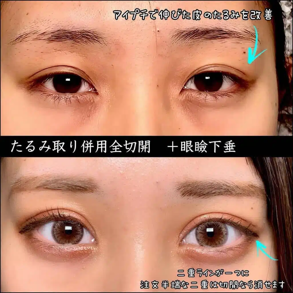 たるみ取り併用全切開+眼瞼下垂 福岡