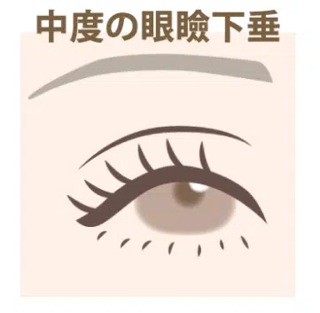 中度の眼瞼下垂 福岡