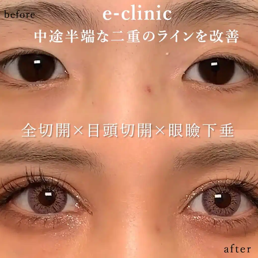 全切開×目頭切開×眼瞼下垂 福岡