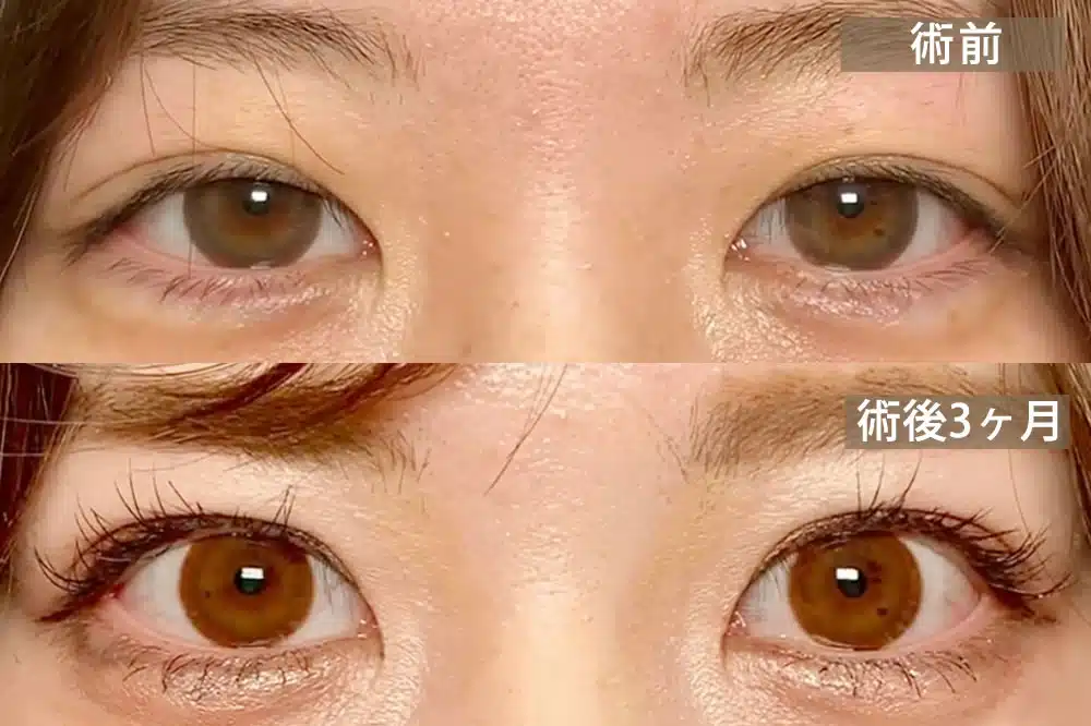 先天性眼瞼下垂 福岡
