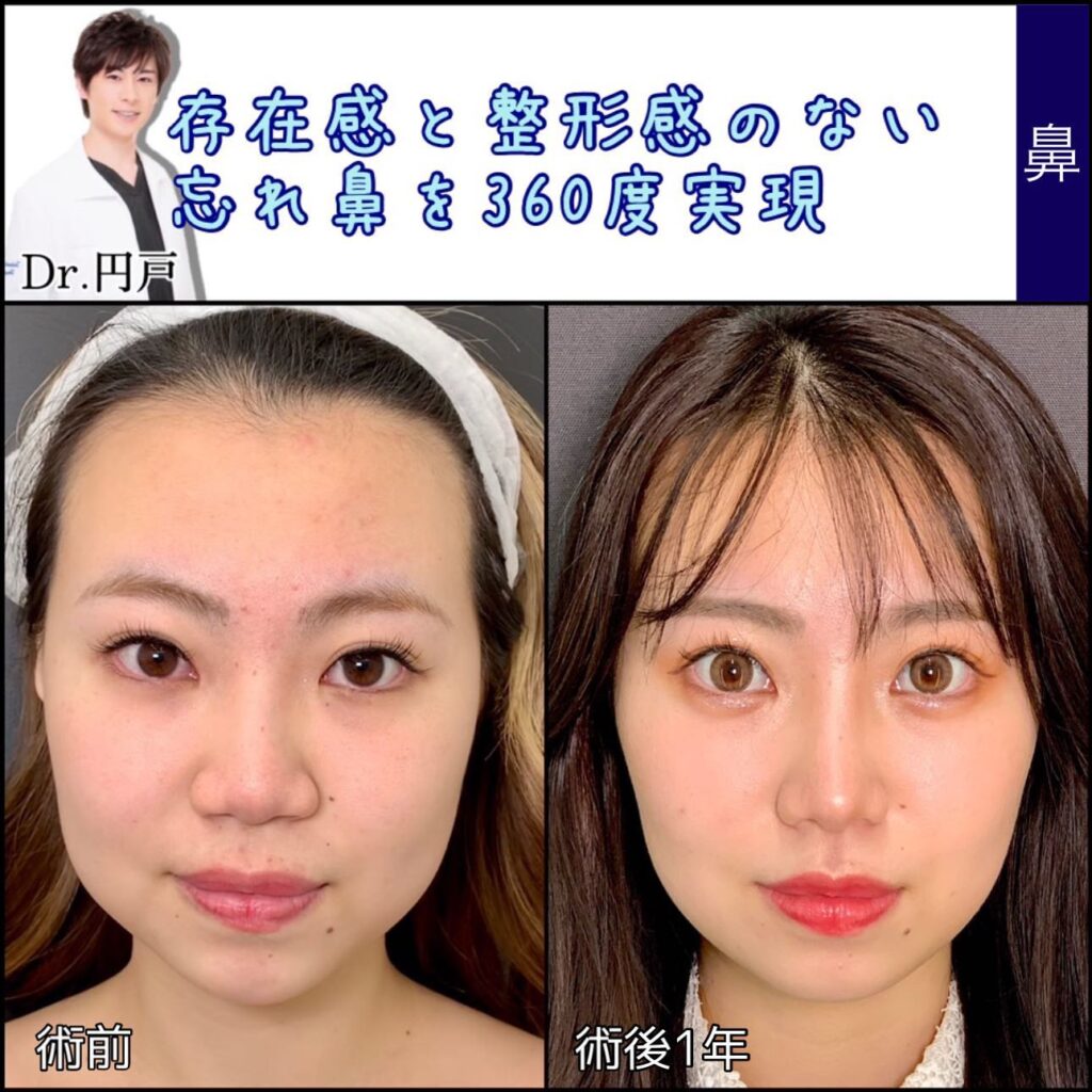 鼻尖形成＋軟骨移植＋鼻中隔延長、法令線基部人口真皮、鼻背部軟骨以上、小鼻縮小を同時に行った症例写真