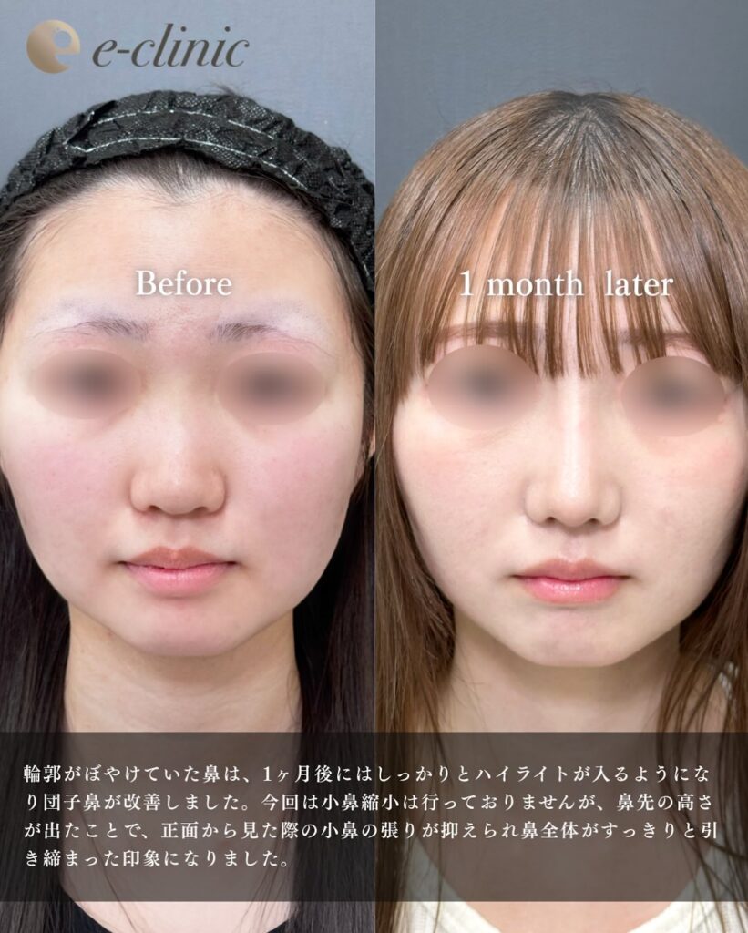 鼻尖形成3D法と鼻尖部と鼻背部筋膜移植または自家真皮移植と鼻プロテーゼの症例写真