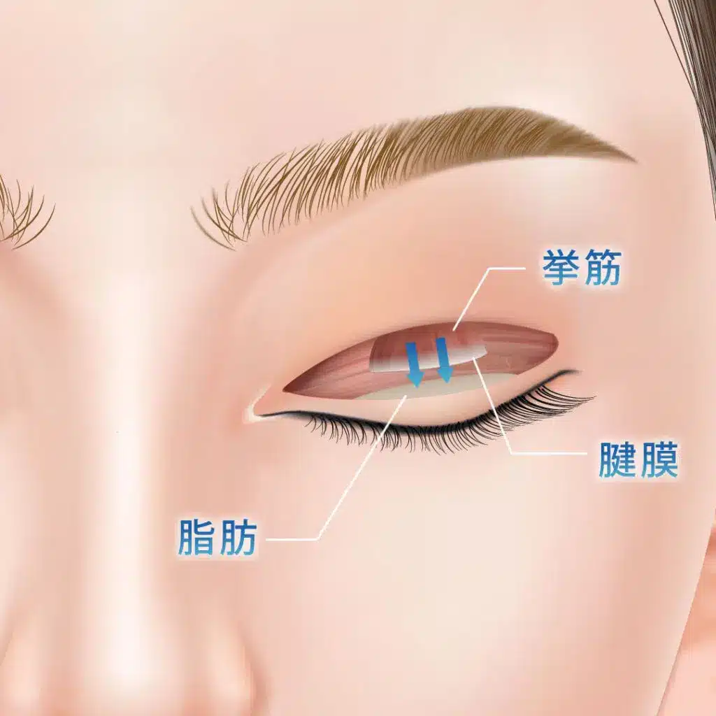 眼瞼下垂 手術方法 福岡