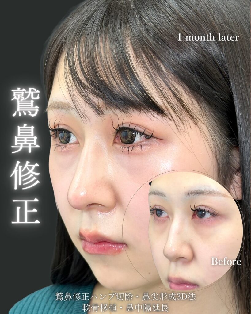 鷲鼻修正と鼻中隔延長と鼻尖形成と軟骨移植の症例写真