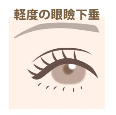 軽度の眼瞼下垂 福岡