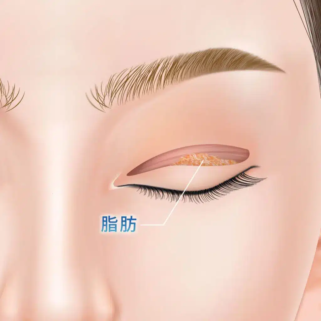 眼瞼下垂 手術方法 福岡