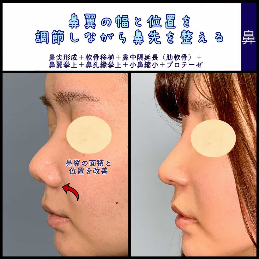 鼻尖形成と軟骨移植と肋軟骨の鼻中隔延長と鼻翼挙上と鼻孔縁挙上と小鼻縮小とプロテーゼを同時にした症例を横から見た写真