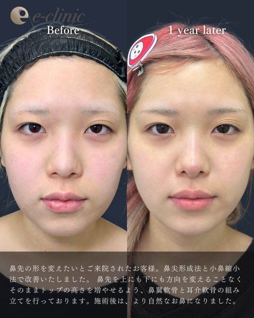 鼻尖形成3D法と軟骨膜移植と小鼻縮小内側法の症例写真