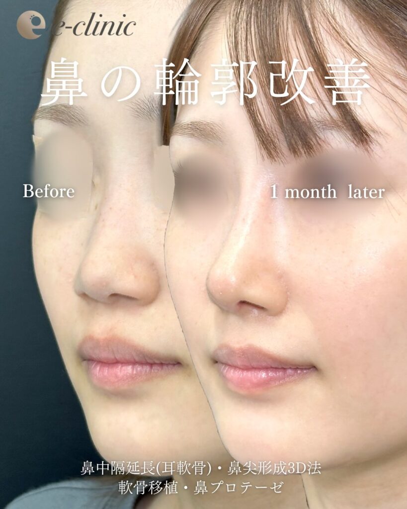 鼻中隔延長と鼻尖形成3D法と軟骨移植と鼻プロテーゼの症例写真