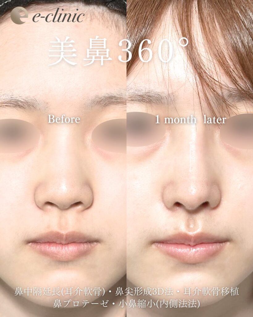 鼻中隔延長(耳介軟骨)と鼻尖形成3D法と耳介軟骨移植と鼻プロテーゼと小鼻縮小(内側法)の症例写真