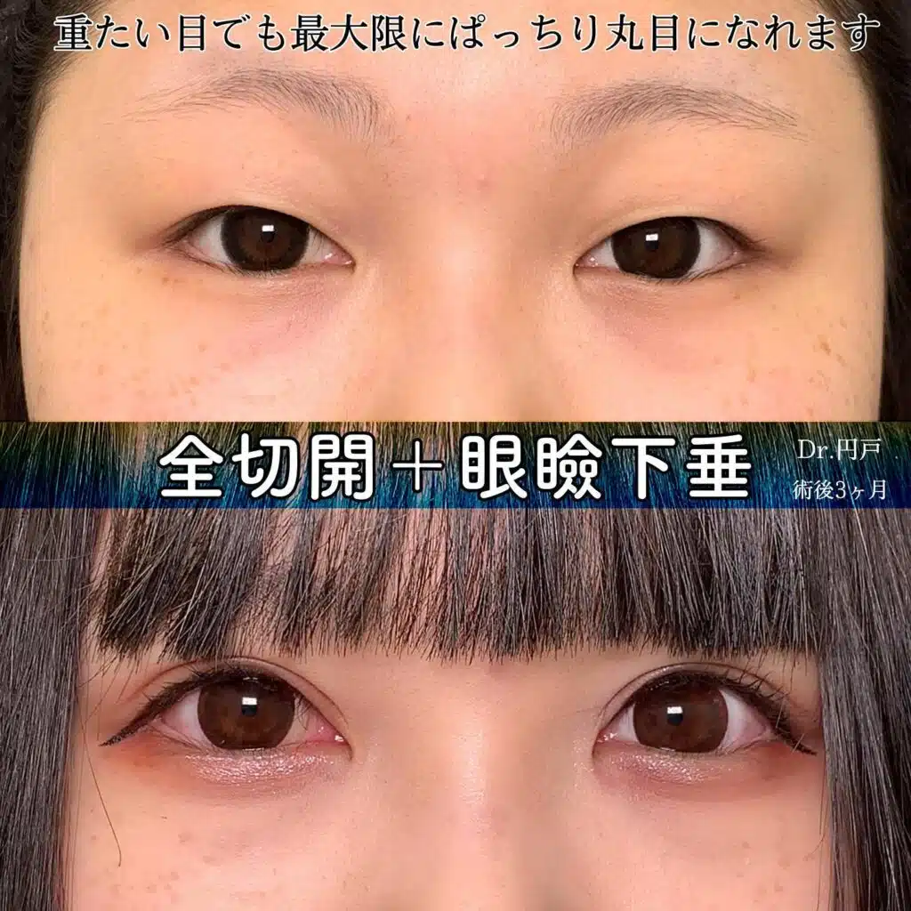 全切開+眼瞼下垂 福岡