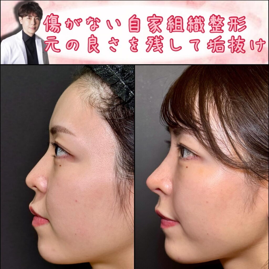 横から見たクローズド法の鼻尖形成と軟骨移植の症例写真