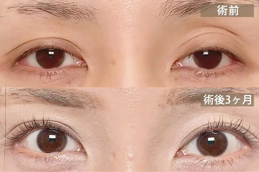 腱膜性眼瞼下垂(後天性眼瞼下垂) 福岡