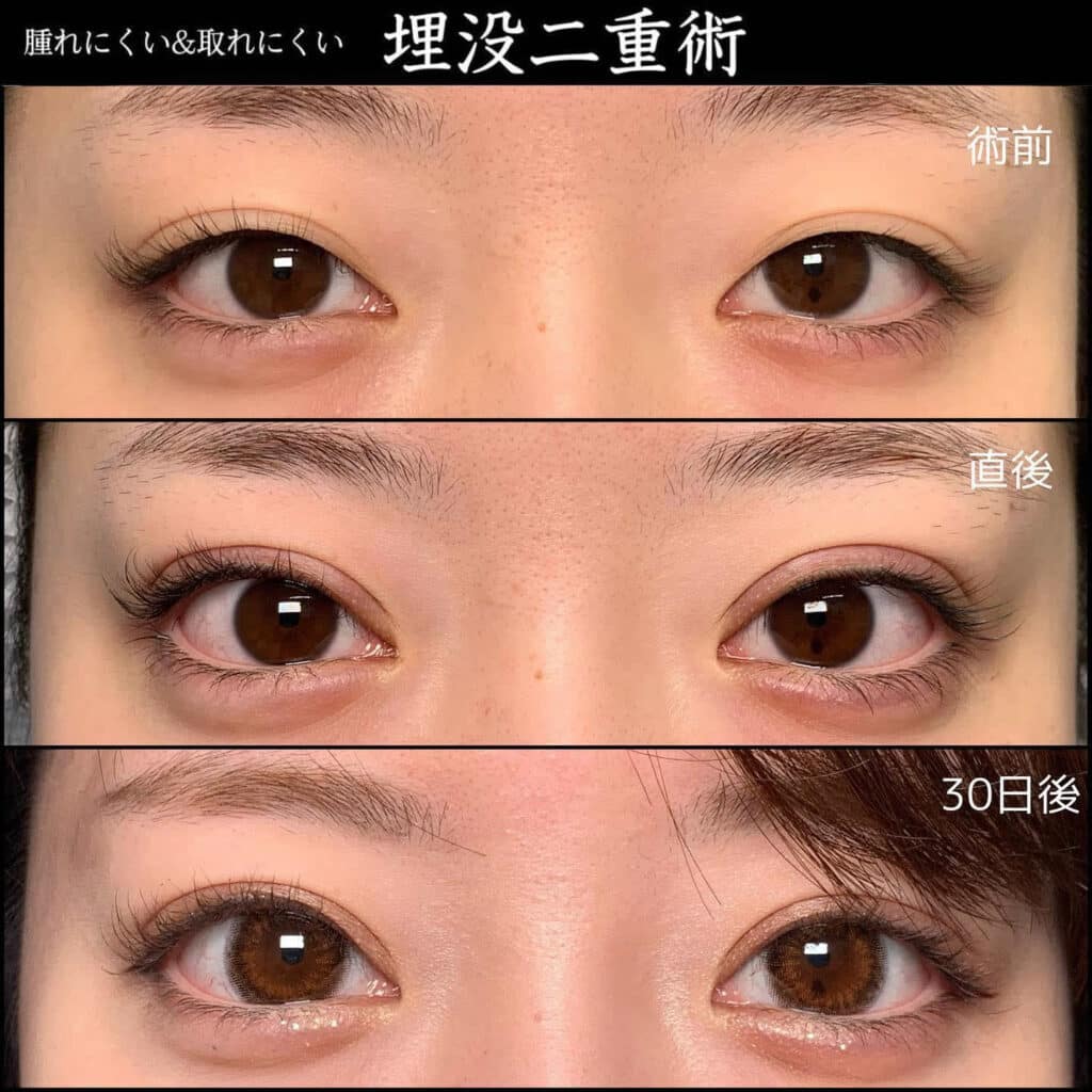 二重埋没法 福岡