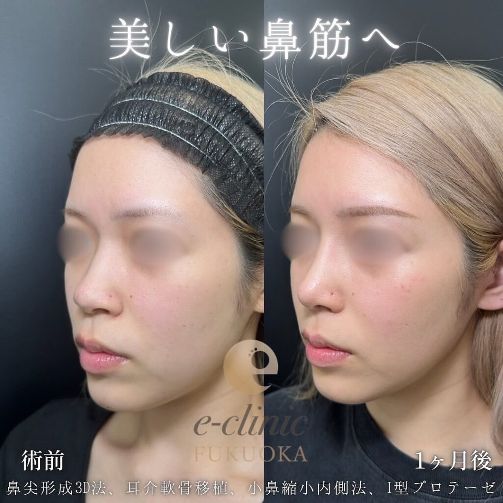 eクリニック福岡院の鼻尖形成3D法と軟骨移植と小鼻縮小とプロテーゼの症例画像