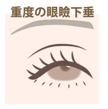 重度の眼瞼下垂 福岡