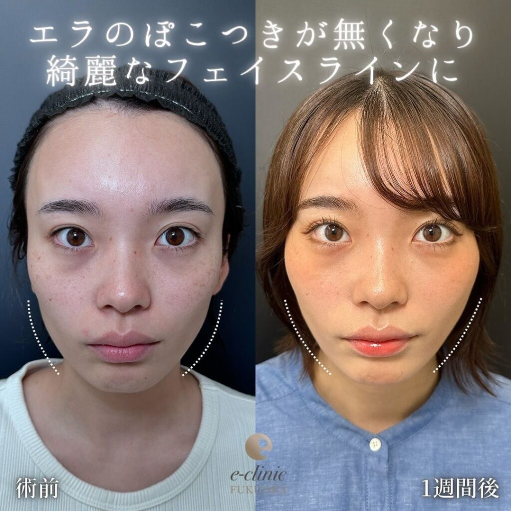 伊藤医師の糸リフトの症例写真