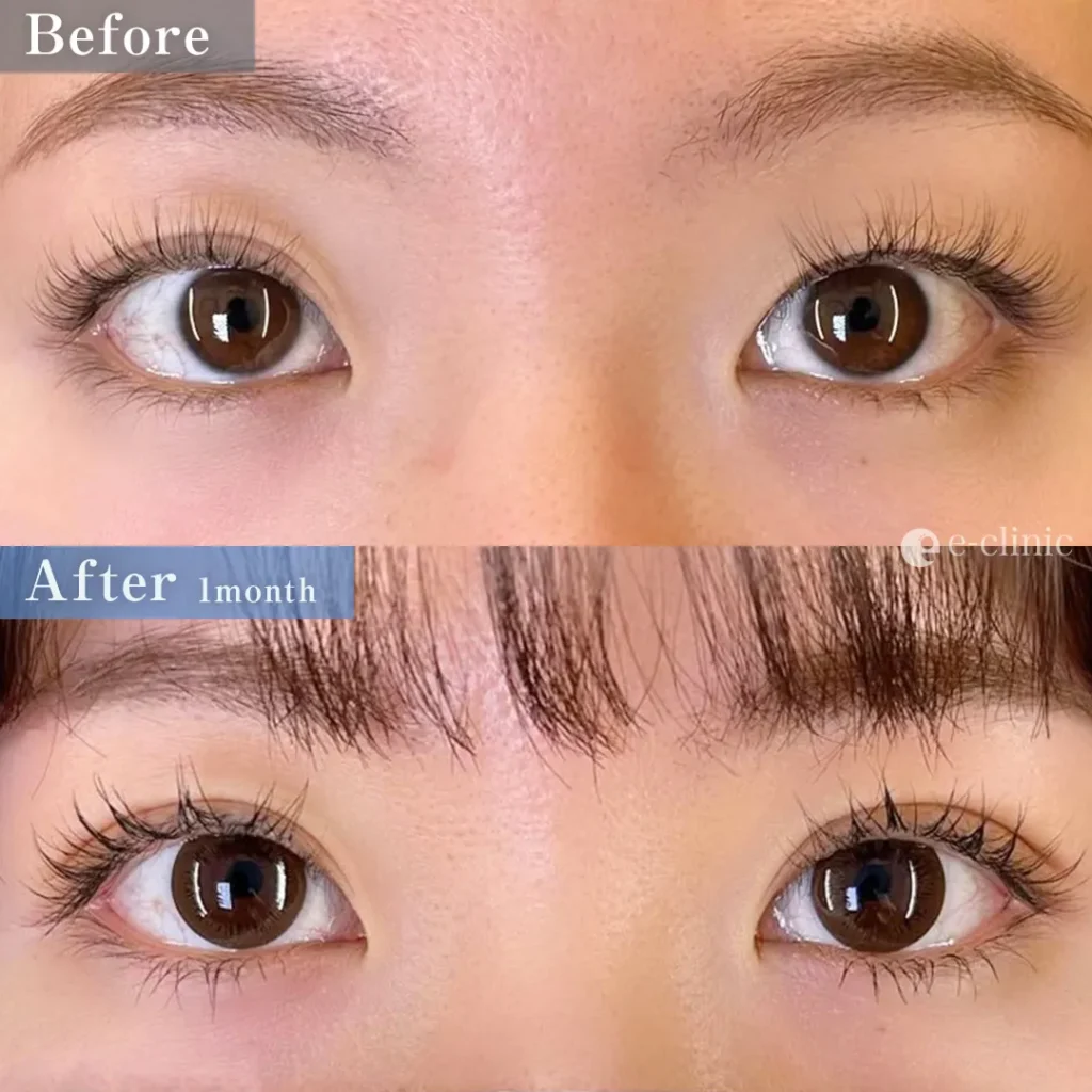 eclinic福岡院の二重埋没法 クイックループダブル4点裏留め