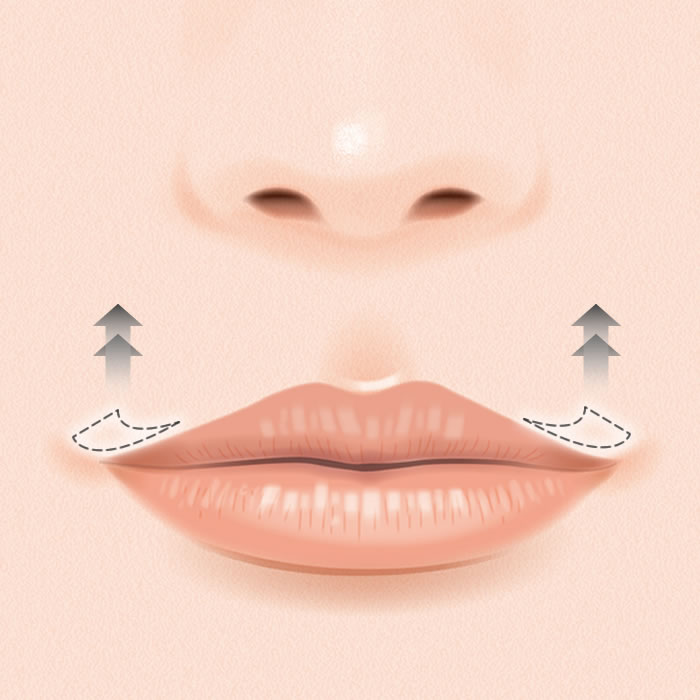 口角挙上のイメージ