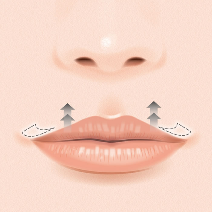 外側人中短縮のイメージ