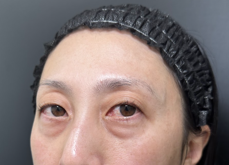 eクリニック福岡院の表ハムラの症例術前写真（名医の伊藤渉医師が執刀）