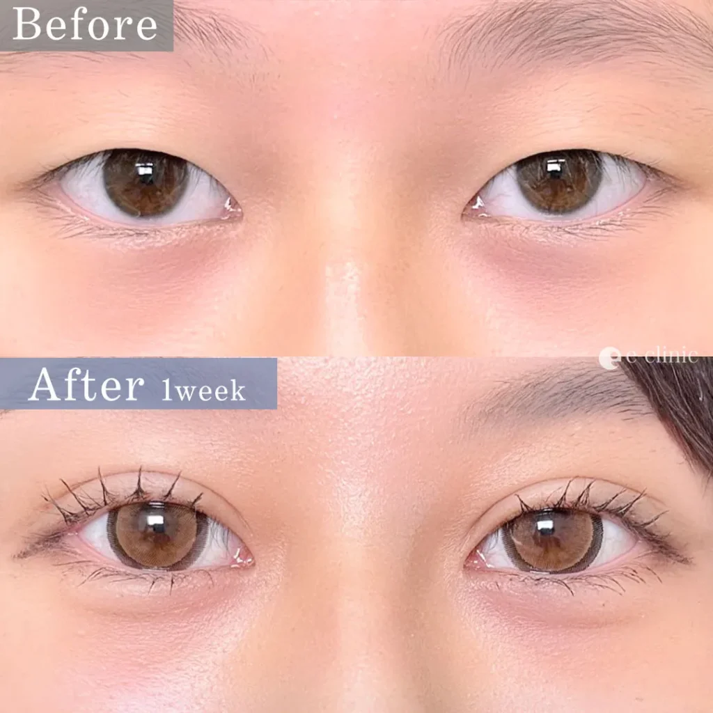 eclinic福岡院の二重埋没 自然癒着法（相原）