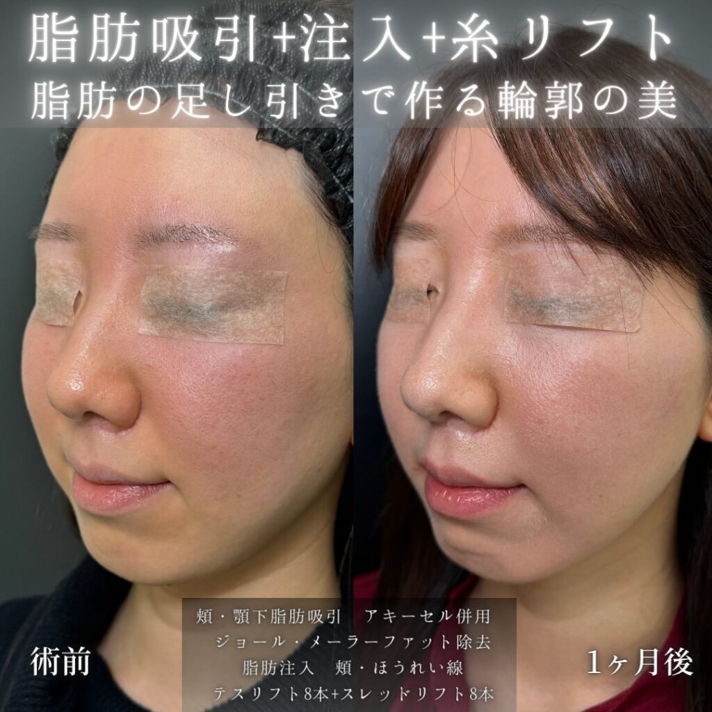 頬と顎下の脂肪吸引とジョール、メーラーファット除去と脂肪注入と糸リフトの症例写真
