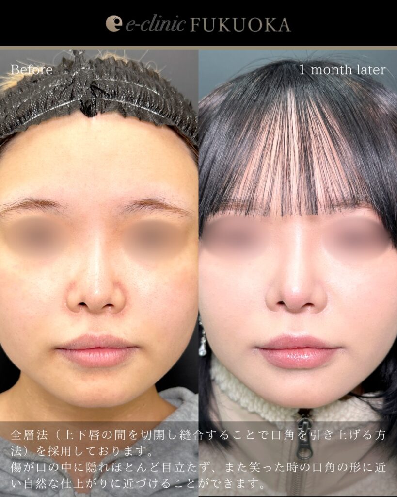 口角挙上の症例写真