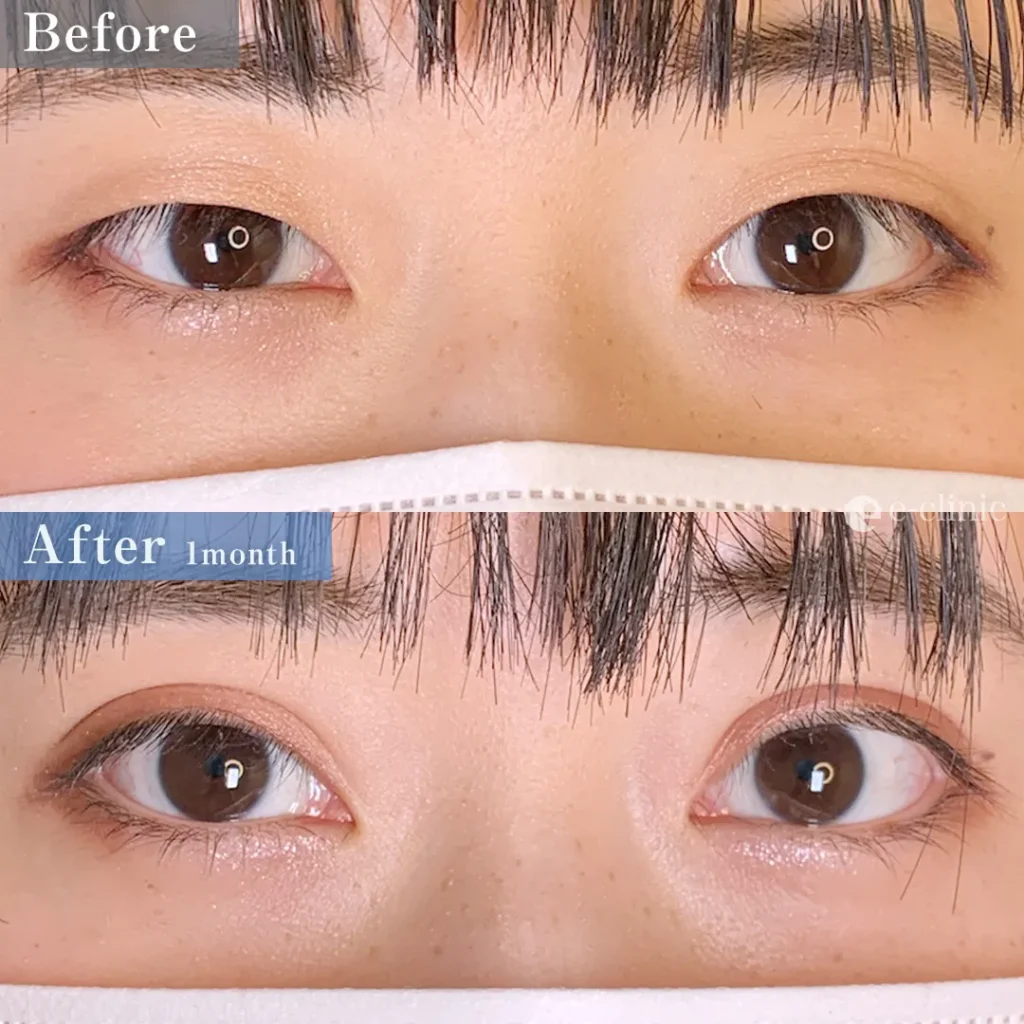 eclinic福岡院の二重埋没法　特殊6点留め（張田）