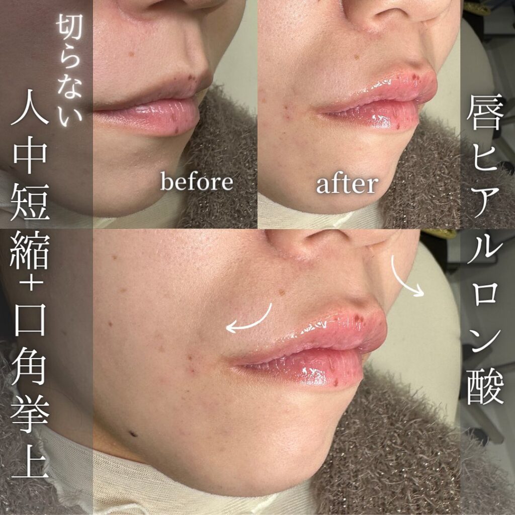 人中短縮と口角挙上とM字リップの症例写真 (1)