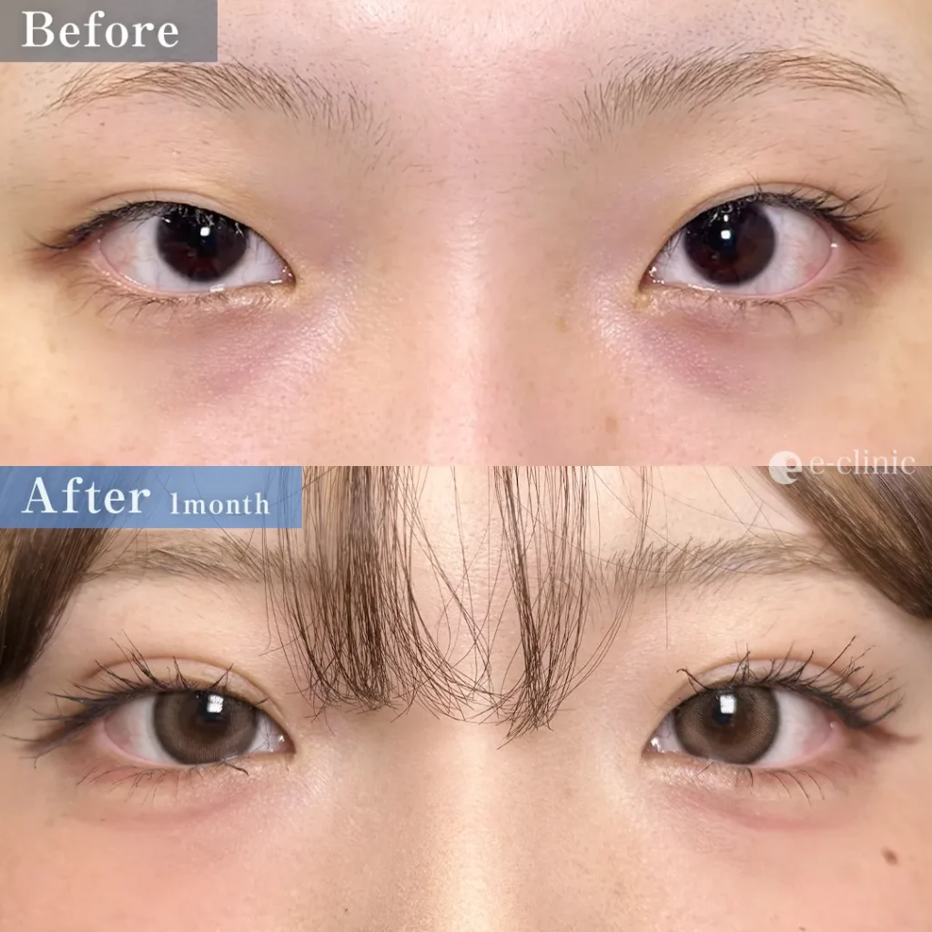 eclinic福岡院の二重埋没法　自然癒着（劉）