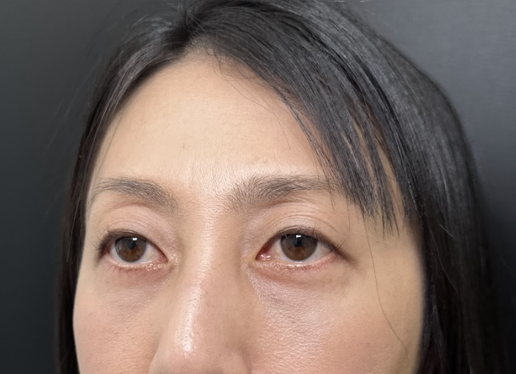 eクリニック福岡院の表ハムラの症例写真（名医の伊藤渉医師が執刀）