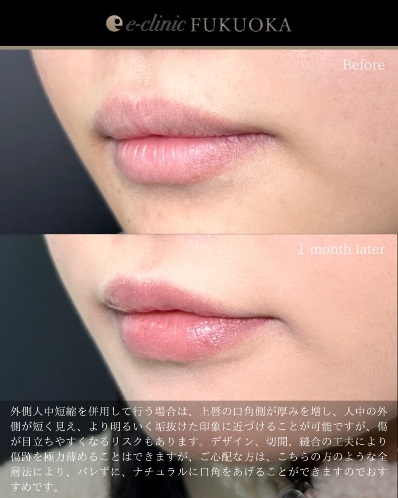 福岡の口角挙上の症例写真