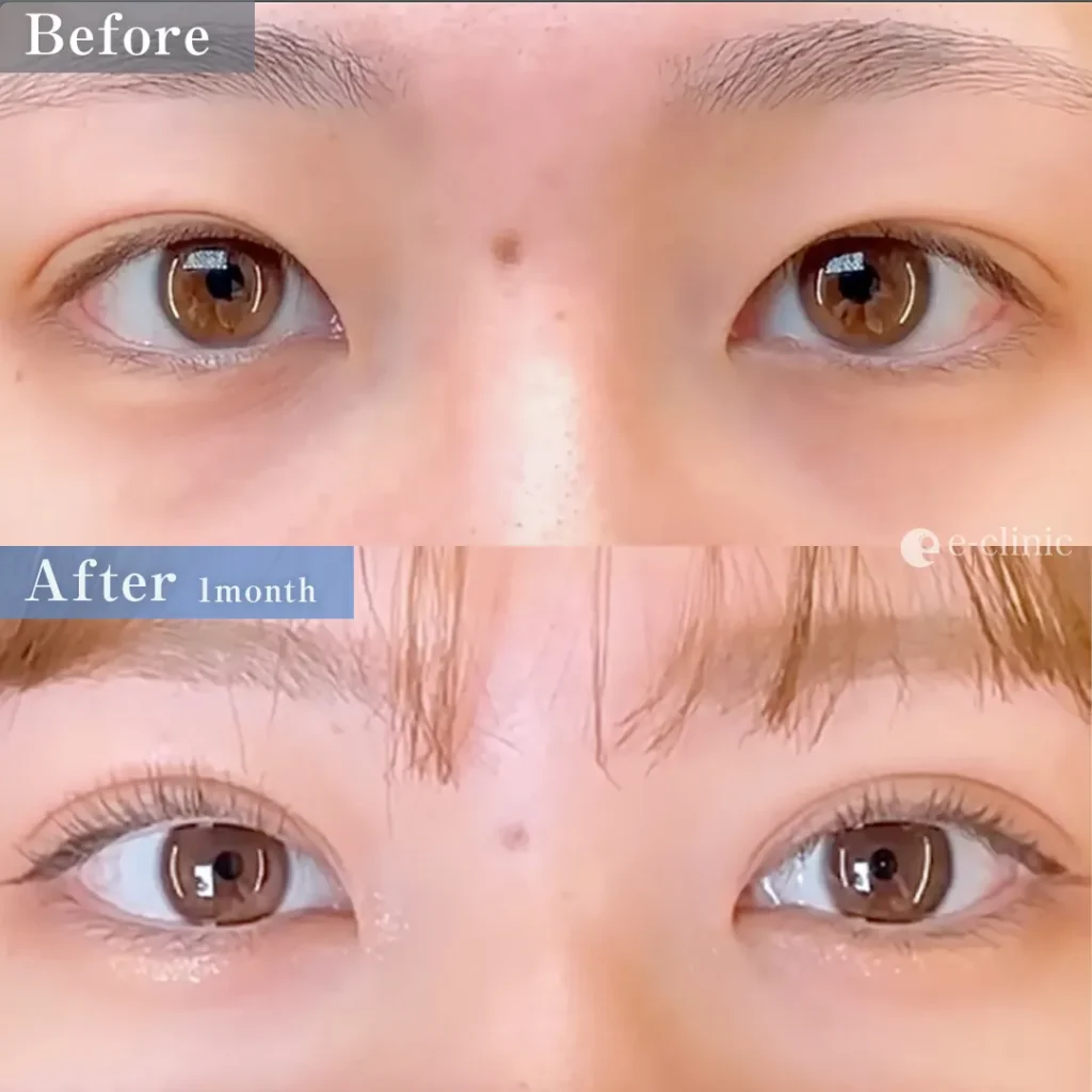 eclinic福岡院の二重埋没法 クイックループダブル4点裏留め（島田）