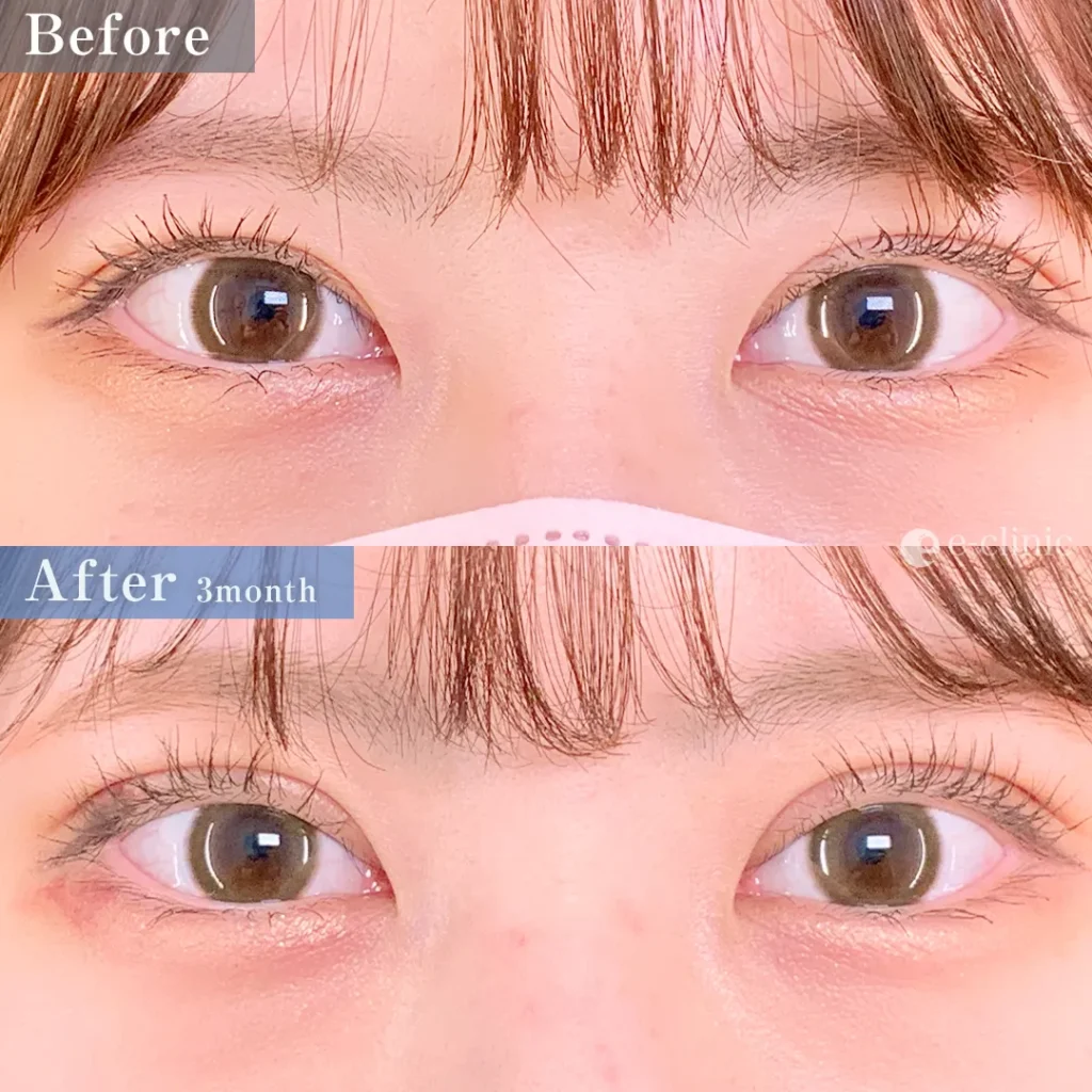 eclinic福岡院の全切開二重術（張田）