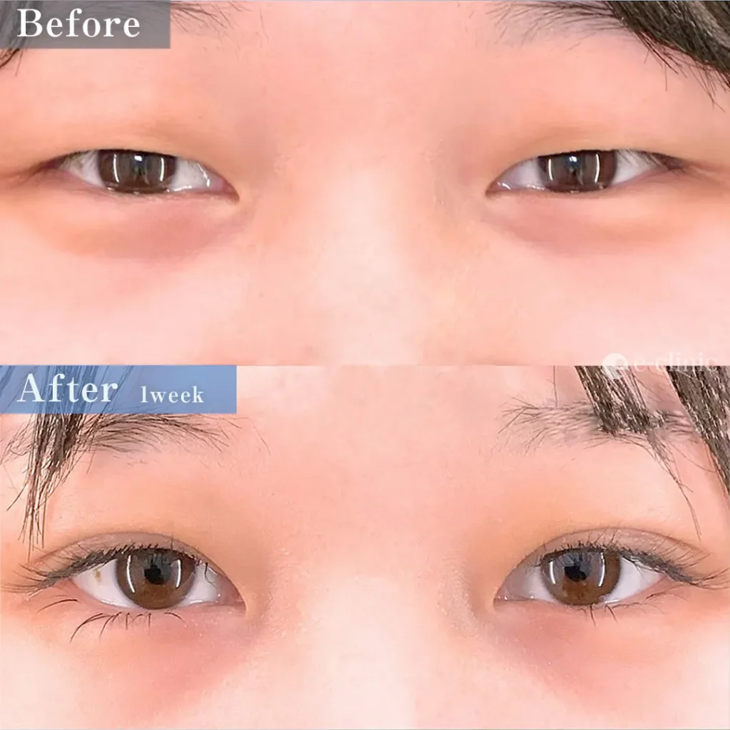 eclinic福岡院の二重埋没法　特殊6裏留め（坂本）