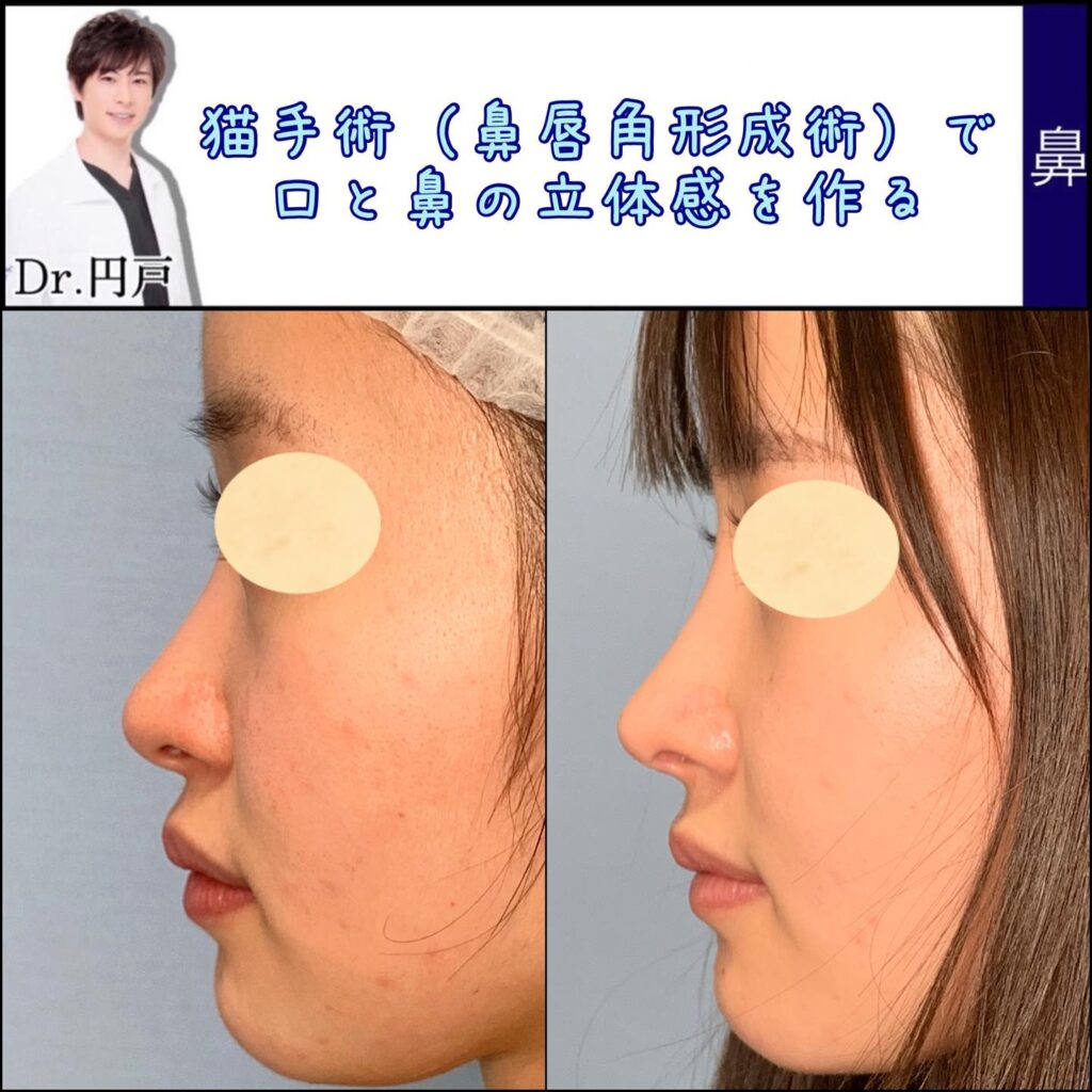 鼻唇角形成術(猫手術)併用した肋軟骨での鼻中隔延長の手術の3ヶ月後 (1)