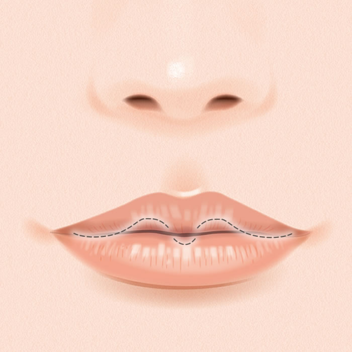 M字リップのイメージ