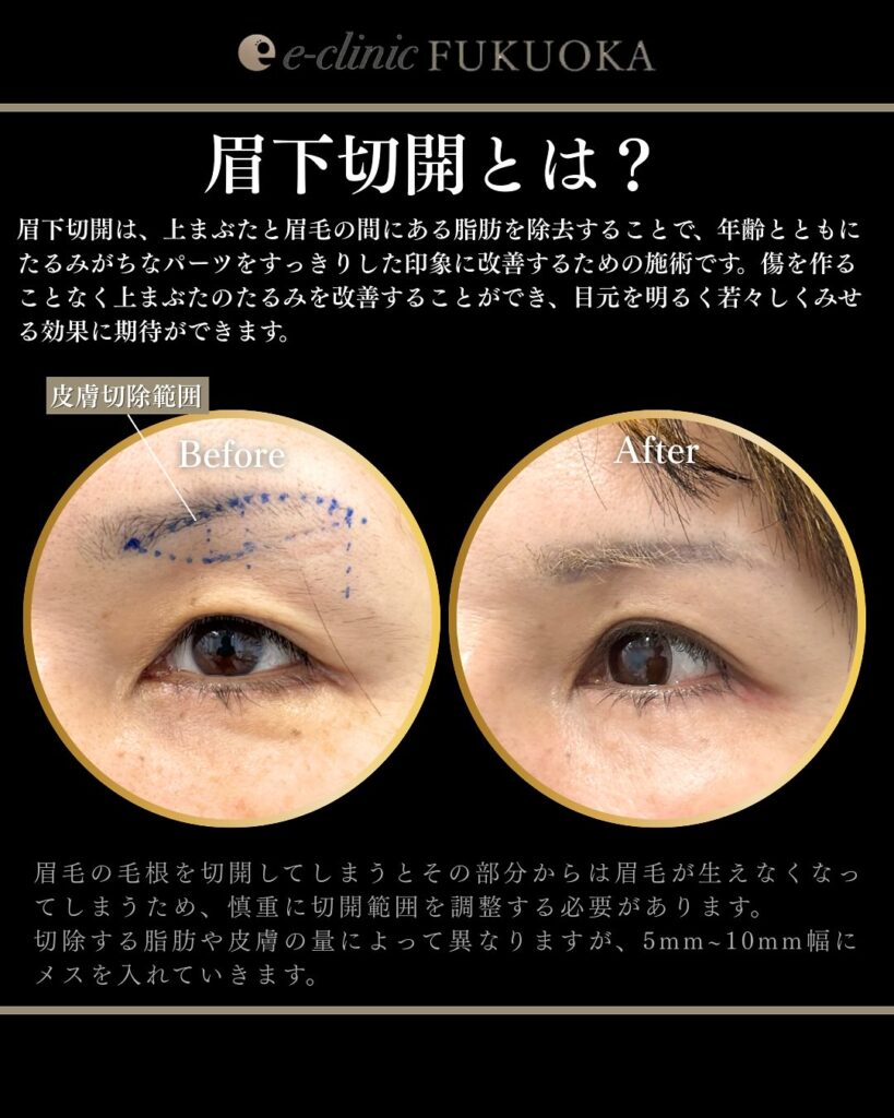 裏ハムラ法と眉下切開の症例写真 (4)