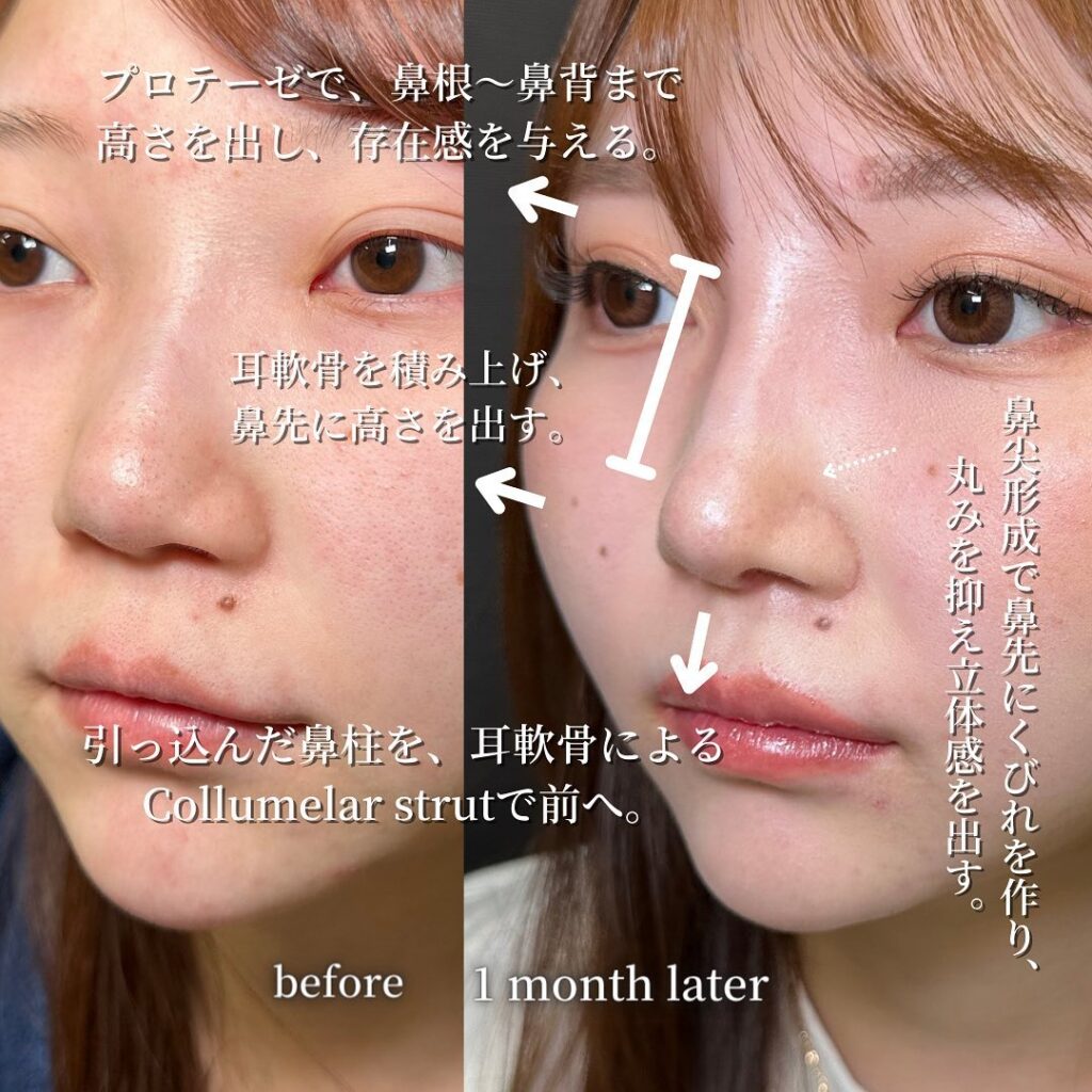 鼻尖形成と軟骨移植とプロテーゼと他院修正の症例写真 (3)