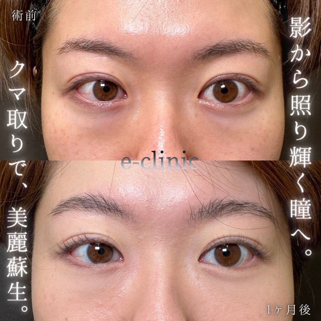 裏ハムラ法の症例写真 (24)