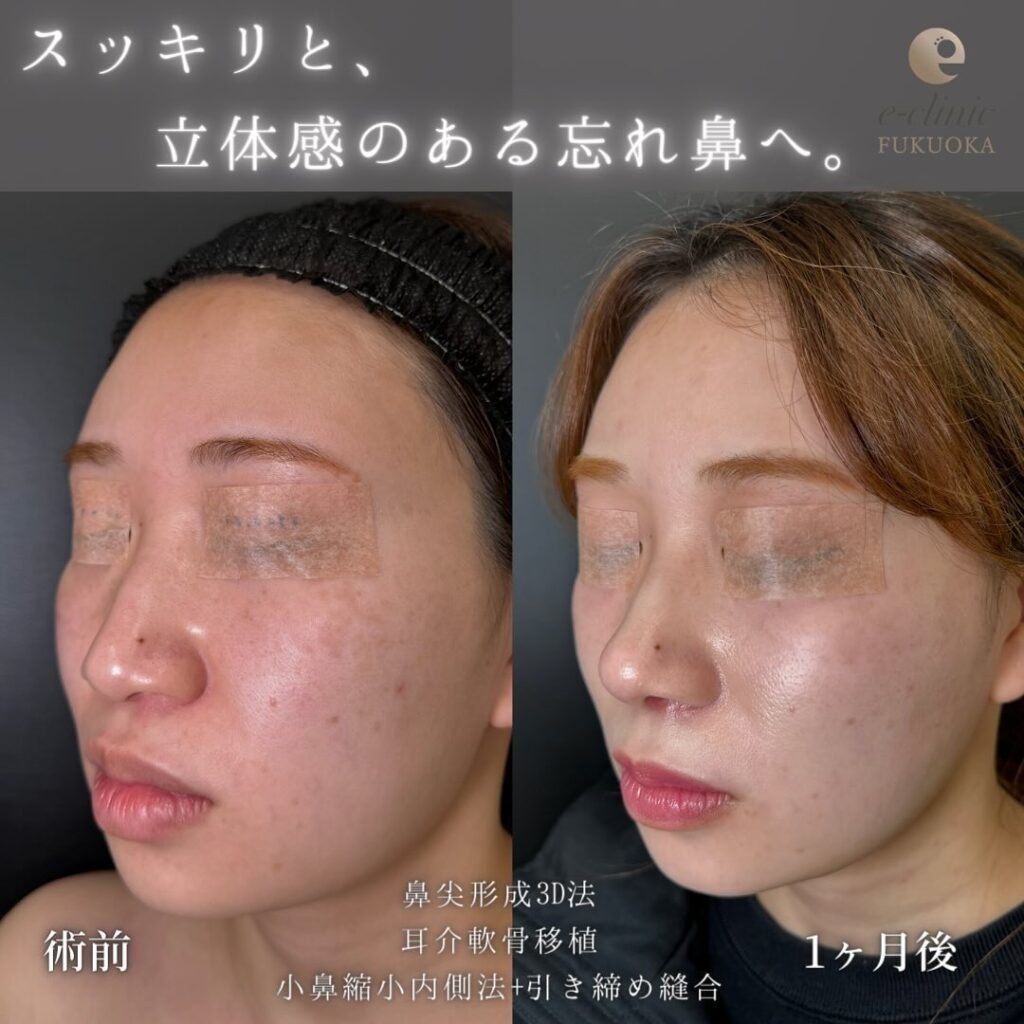 鼻尖形成と軟骨移植と小鼻縮小の症例写真 (12)